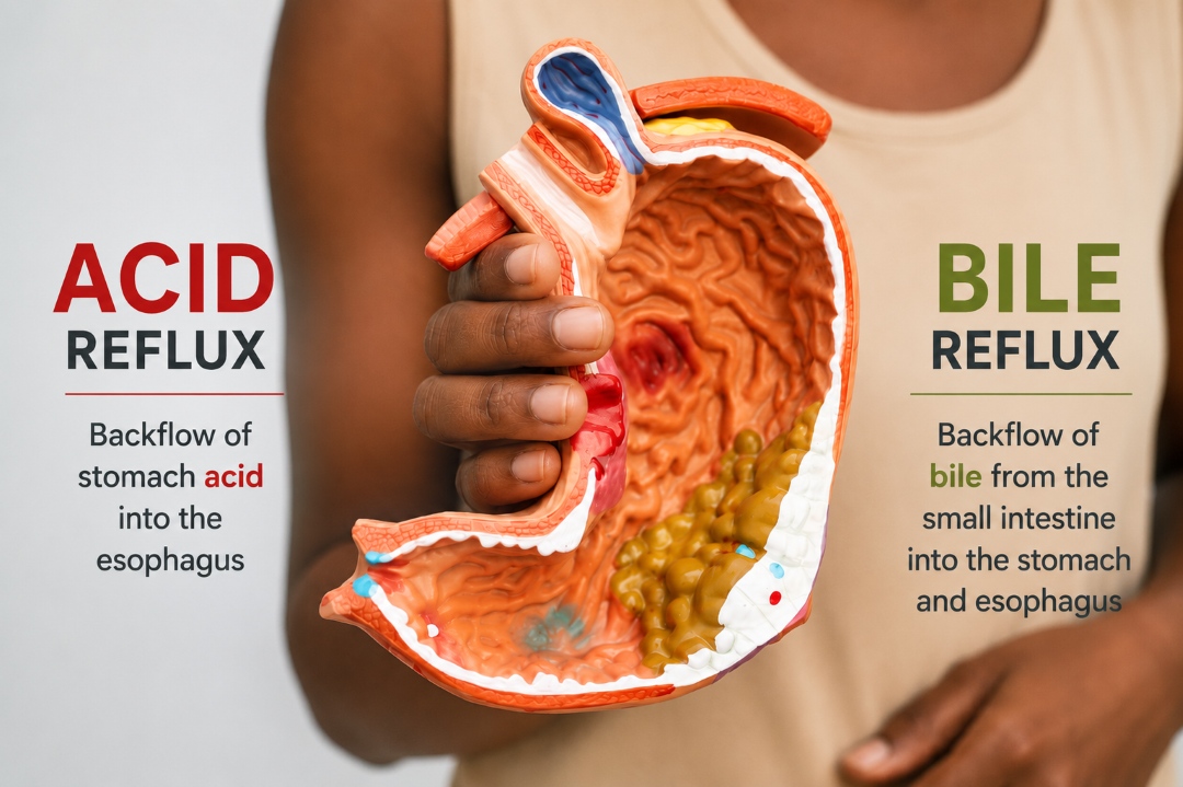 Understanding Acid vs Bile Reflux